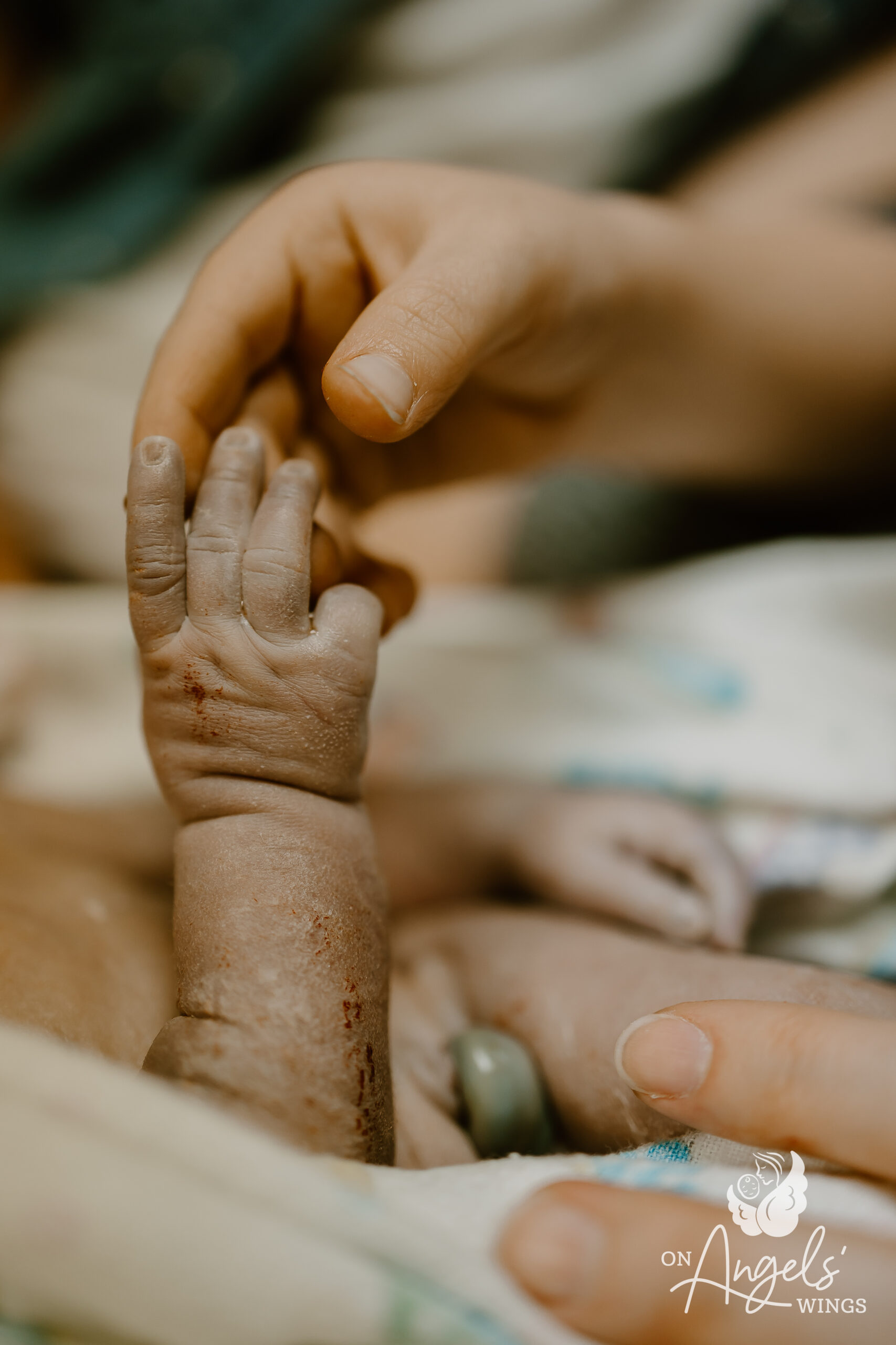 What is Anencephaly? - On Angels Wings